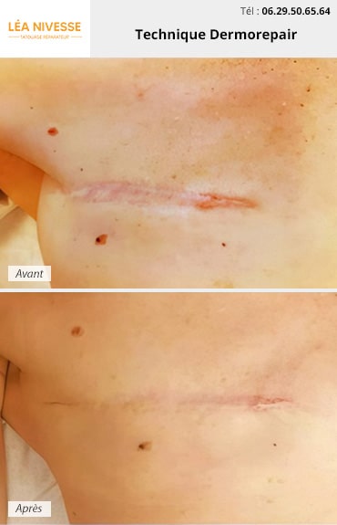 Photo avant / après de la technique Dermorepair