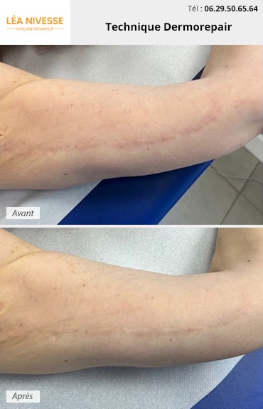 Résultat avant / après de la technique Dermorepair sur une cicatrice sur le bras