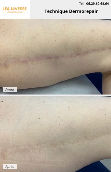 Résultat avant / après de la technique Dermorepair sur une cicatrice sur la jambe