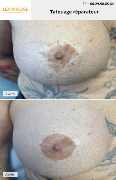 Résultat tatouage réparateur poitrine