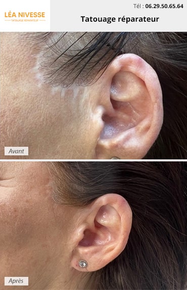 Résultat avant / après tatouage réparateur oreille
