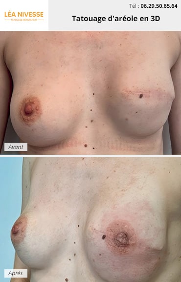 Résultat avant / après tatouage aréole en 3D